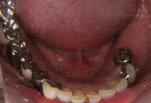 下顎大臼歯2歯インプラント補綴治療の症例の写真、その1