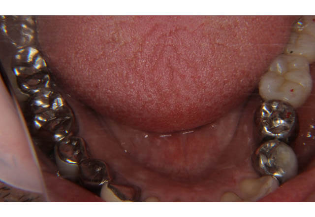 下顎大臼歯2歯インプラント補綴治療の症例の写真、その2