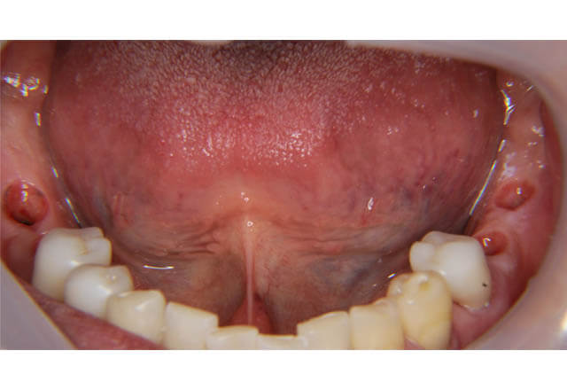 下顎大臼歯4歯インプラント補綴治療の症例の写真、その1