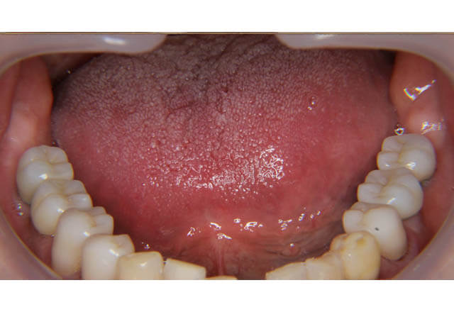 下顎大臼歯4歯インプラント補綴治療の症例の写真、その2