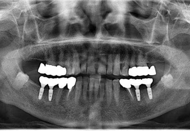 下顎大臼歯4歯インプラント補綴治療の症例の写真、その3