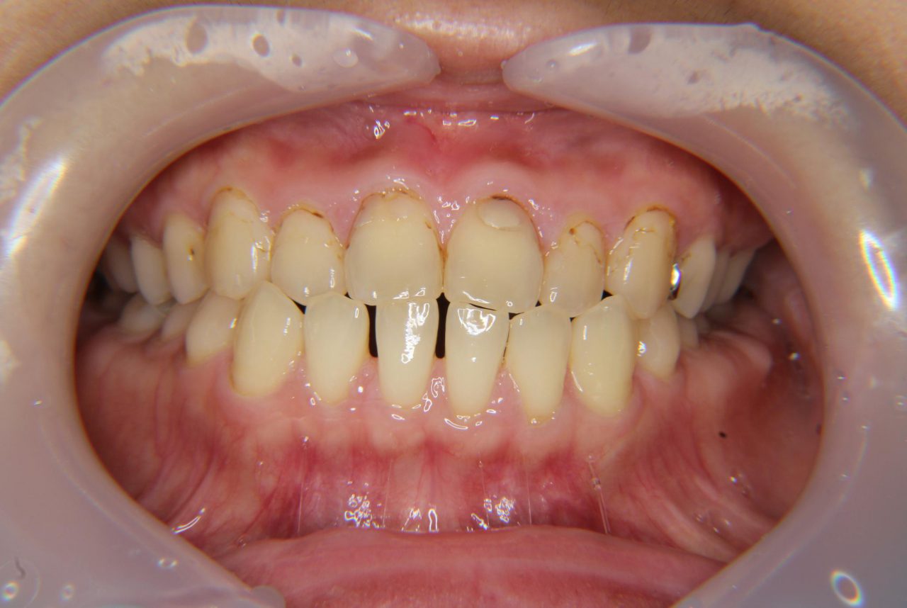 歯 の 詰め物 白く する